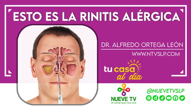 Esto es la rinitis alérgica