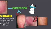 Get rid of chicken skin (Keratosis Pilaris) at home