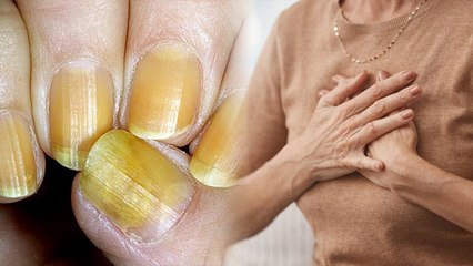 नाखून पीले क्यों होते है । Yellow Nail Syndrome Kya Hota Hai । Boldsky