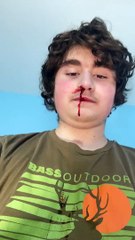 My nose started bleeding