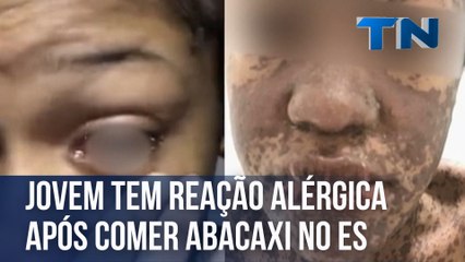 Jovem tem reação alérgica após comer abacaxi no ES