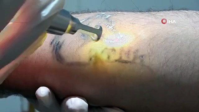 Uzmanından lazer epilasyon uyarısı: Yüz bölgesine yapılan lazer epilasyonlarında yüzde 90 sonuç alınamıyor