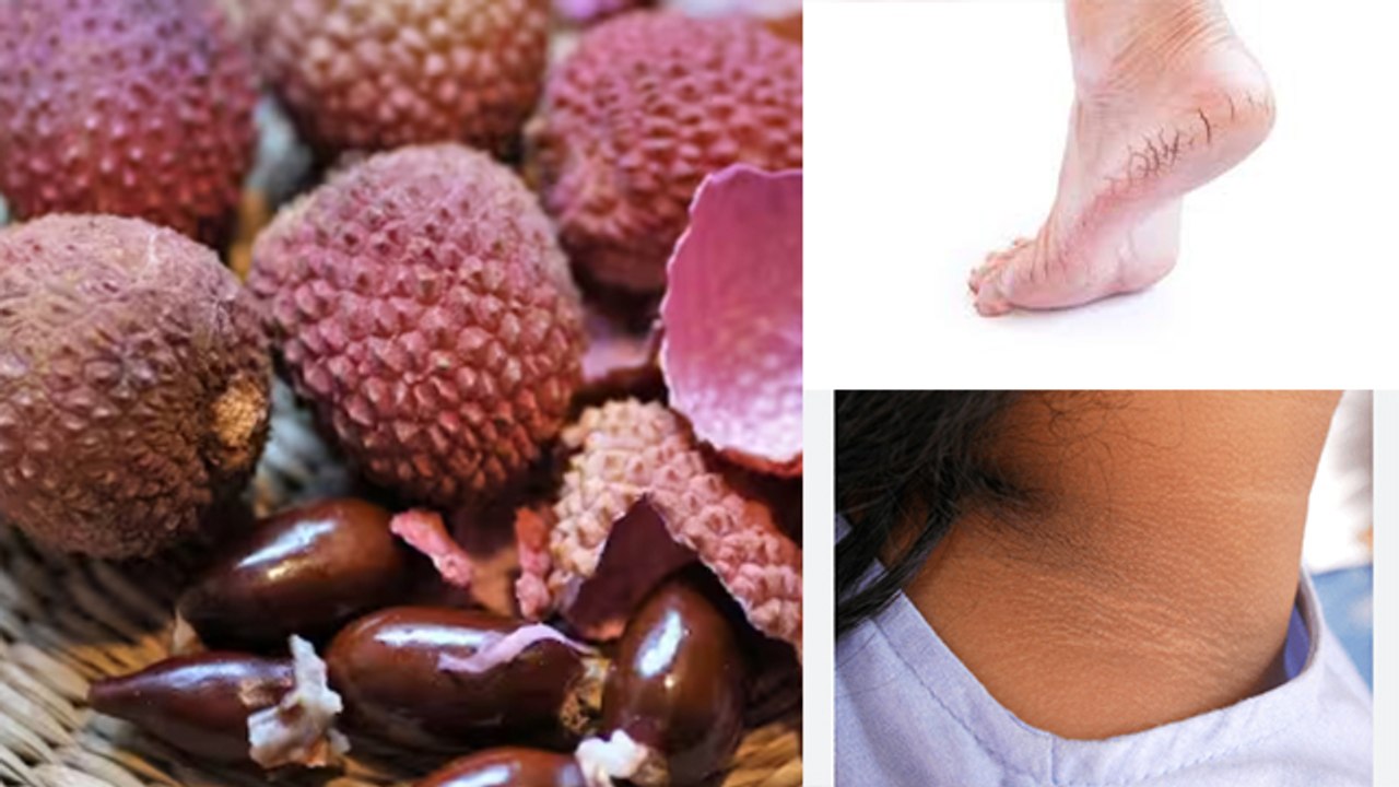लीची के छिलके के फायदे चौंकाने वाले, Neck Tanning से लेकर Cracked Heels तक में Beneficial | Boldsky