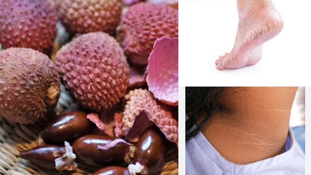 लीची के छिलके के फायदे चौंकाने वाले, Neck Tanning से लेकर Cracked Heels तक में Beneficial | Boldsky
