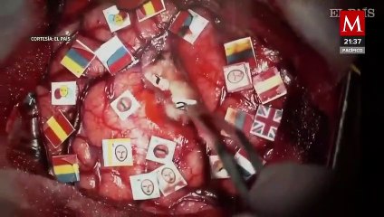 Una mujer es operada del cerebro despierta, para no perder sus 5 idiomas aprendidos