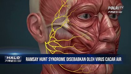 Fakta Apa Itu Ramsay Hunt Syndrome yang Diderita Justin Bieber