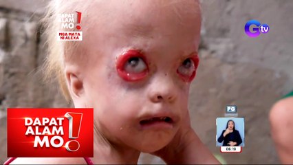 3-anyos na bata, walang talukap at pilikmata! | Dapat Alam Mo!