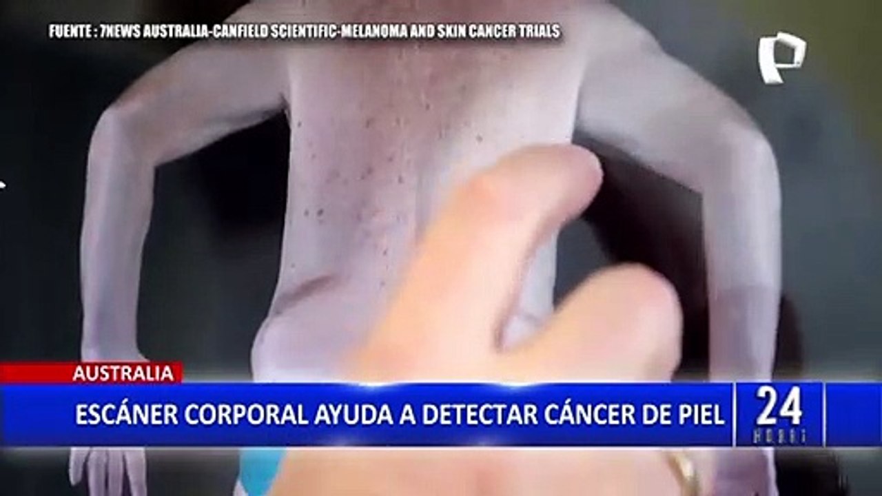 Australia: lanzan escáner corporal que ayuda a detectar cáncer de piel