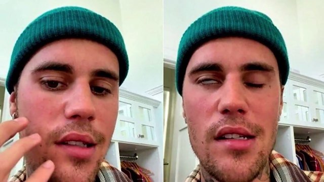 Justin Bieber'in geçirdiği Ramsay Hunt Sendromu nedir? Ramsay Hunt Sendromu belirtileri nelerdir?