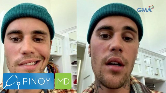 Pagkaparalisa ng kalahati ng mukha ni Justin Bieber, ano nga ba ang dahilan? | Pinoy MD