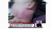 Leeg ng isang babae, namaga matapos niyang magpatanggal ng wisdom tooth | 24 Oras Weekend