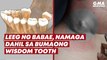 Leeg ng babae, namaga dahil sa bumaong wisdom tooth | GMA News Feed