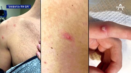 살 닿는 밀접접촉 통해 전파…원숭이두창 Q&A