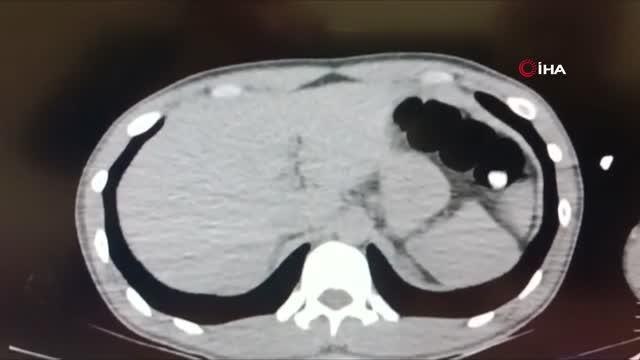 İran uyruklu şahsın mide ve bağırsağından 1 kilo 126 gram uyuşturucu çıktı