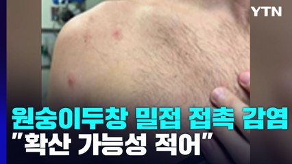원숭이두창, 밀접 접촉으로 감염..."확산 가능성 적어" / YTN