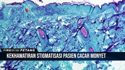 Stigmatisasi Pengidap Cacar Monyet Bisa Hambat Pengendalian Perebakan