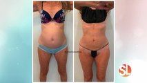 UGlow Face & Body: Get the body you want with FirmSculpt® body contouring