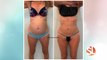 UGlow Face & Body: Get the body you want with FirmSculpt® body contouring