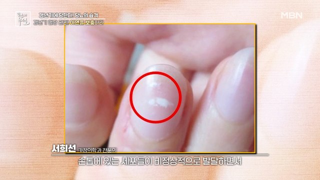 '필수 미네랄' 아연 부족 신호, 손을 보면 알 수 있다?