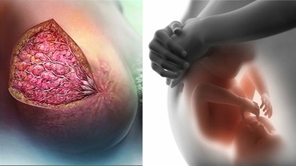 Breast Cancer Treatment के बाद Pregnant होने का Chance कितना, EXPERT ADVICE | Boldsky *Health