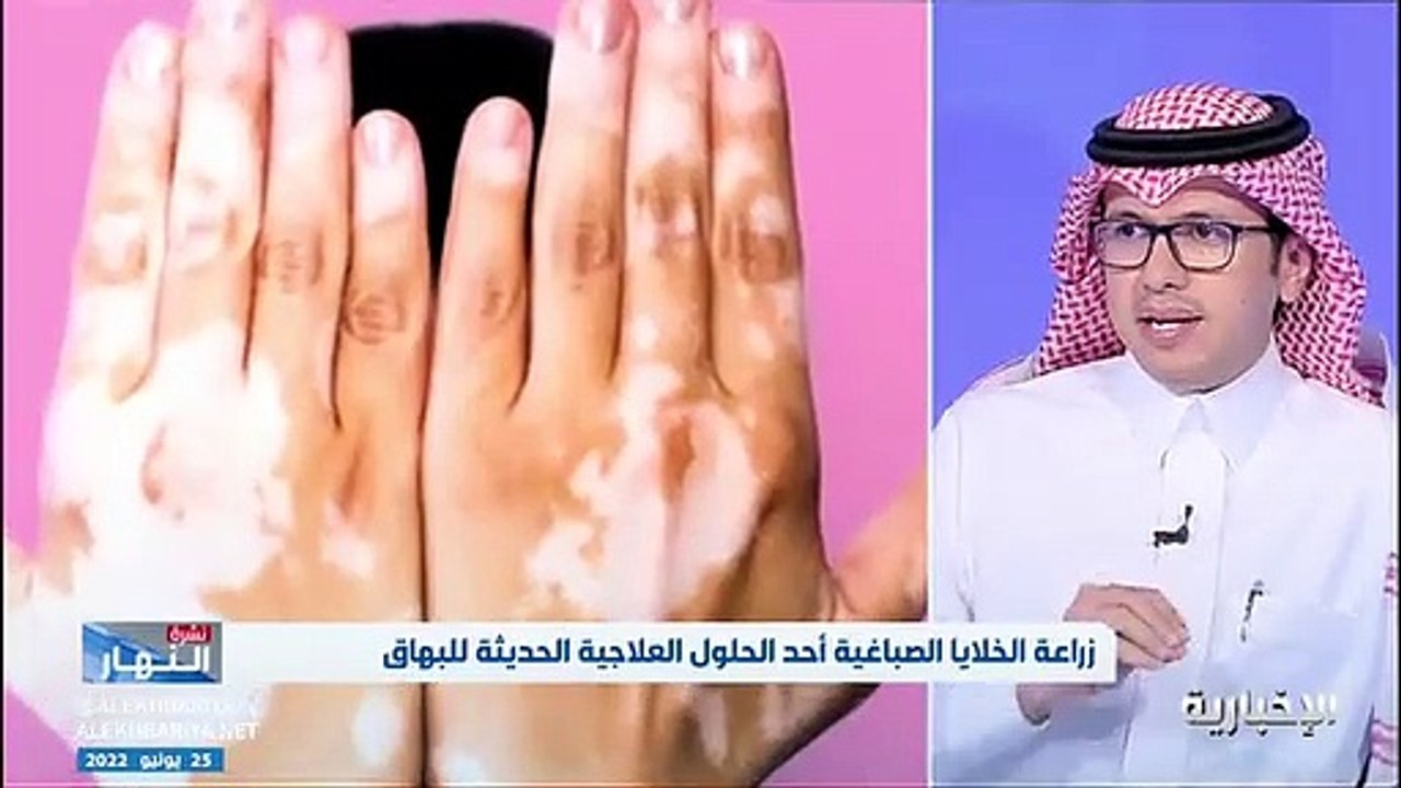 فيديو استشاري طب الأمراض الجلدية وجراحة الليزر - في مدينة الملك فهد الطبية د. محمد العجلان مرض البهاق غير معدي ذاتي المناعة.. ولا يوجد أبر لتوحيد ل