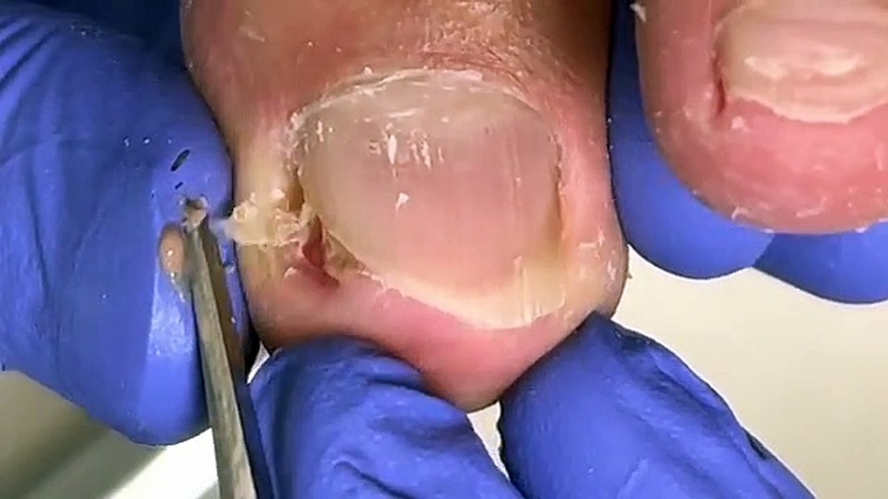 Oversized-ingrown-nails-that-haven-t-been-trimmed