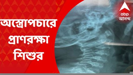 SSKM Operation: SSKM হাসপাতালে জটিল অস্ত্রোপচার, দেড় বছরের শিশুর গলা থেকে বের হল দারুচিনি