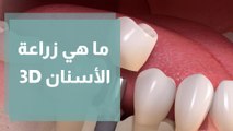 كيف تتم عملية زراعة الأسنان 3D، وهل هي مؤلمة؟