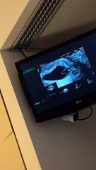 Τα βίντεο με τον υπέρηχο και την συγκίνηση της Super Κικής