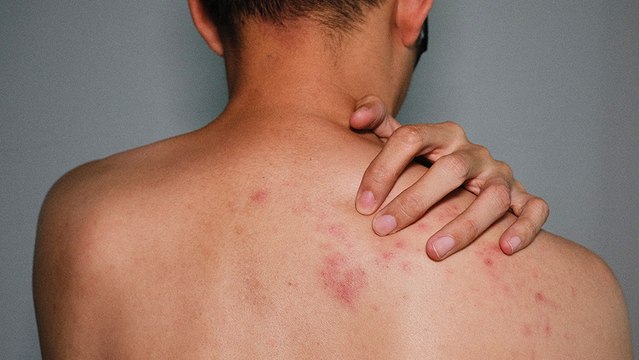 bd-causas-complicaciones-y-tratamientos-del-herpes-zoster-270622