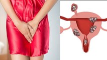Vulvar Cancer: क्या आप जानते है महिलाओं में होने वाले इस कैंसर के बारे में | वल्वर कैंसर | Boldsky