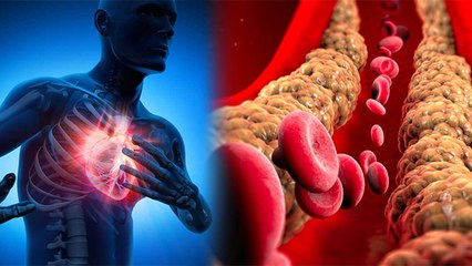 Bad Cholesterol बढ़ने का कारण | Bad Cholestrol क्यों बढ़ता है | Boldsky *Health