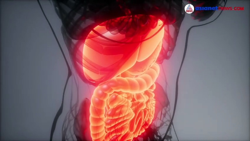 gastroparesis | രോഗം അപൂര്‍വങ്ങളില്‍ അപൂര്‍വം;വലഞ്ഞ് യുവതി, കൃത്യമായ കാരണം കണ്ടെത്താനാകാതെ ഡോക്ടര്‍മാര്‍