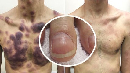 Finger Clubbing क्या है, Lung Cancer से लेकर Heart Disease तक का Symptom | Boldsky *Health