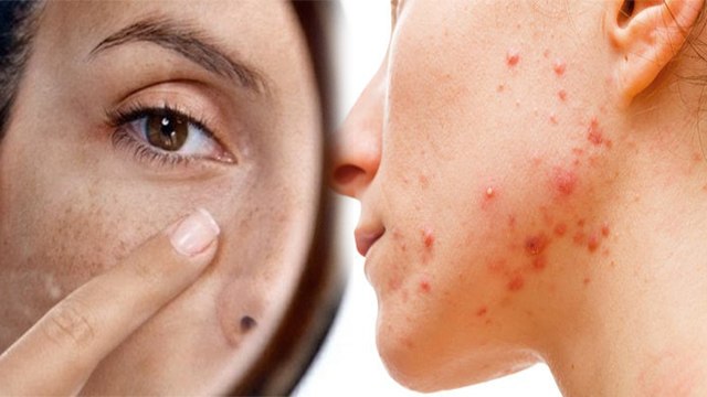 Face पर Diabetes Symptoms नजरअंदाज करने पर Blood Sugar Control मुश्किल | Boldsky *Health