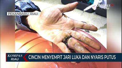 Cincin Menyempit Jari Luka Dan Nyaris Putus