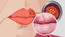 होंठ पर सफेद दाने Fordyce Spot Symptoms, Lips White Spots क्यों होता है | Boldsky *Health