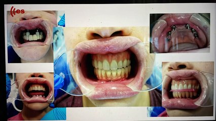 Qué me pasa, doctor: Devolverle la sonrisa a los niños con rehabilitación dental