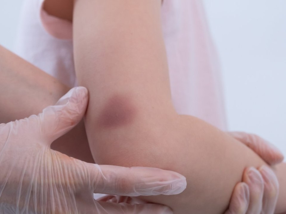 Hässliche, blaue Flecken am Körper? Diese Methode wirkt Wunder!