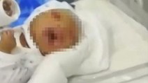 Kalıtımsal hastalıkla doğan bebek hastaneyi alarma geçirdi, yüzünü gören doktorlar dehşete kapıldı