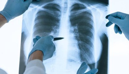 Aumento de casos de tuberculose e abandono de tratamento gera preocupação na Paraíba, alerta SES