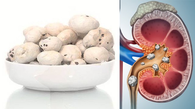 किडनी पथरी होने पर मखाना खाना सही या गलत । पथरी में मखाना खाने से क्या होता है । Boldsky *Health