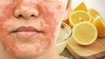 Face पर Lemon लगाने से क्या होता है | चेहरे पर नींबू लगाने से क्या होता है | Boldsky *Health