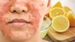 Face पर Lemon लगाने से क्या होता है | चेहरे पर नींबू लगाने से क्या होता है | Boldsky *Health