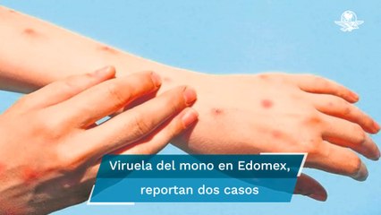 Viruela del mono. Estado de México registra dos casos