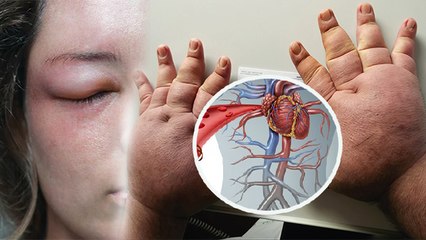 हाथ-पैर और चेहरे की सूजन इस गंभीर बीमारियों का संकेत,नजरअंदाज करना जानलेवा | Boldsky *Health