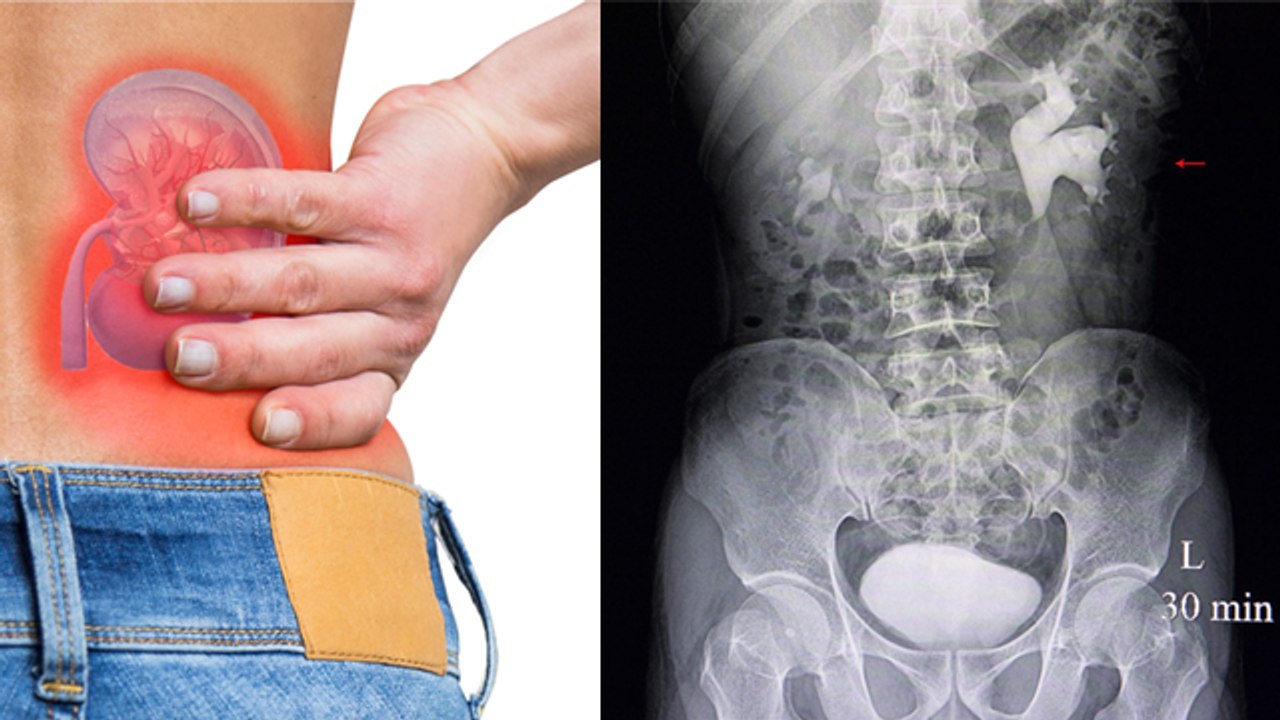 किडनी में पथरी क्यों होती है | Kidney Me Stone Kyu Hota Hai | Boldsky *Kidney