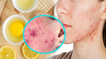 चेहरे पर अंडा लगाना चाहिए या नहीं | चेहरे पर अंडा लगाने के नुकसान |Boldsky*Health