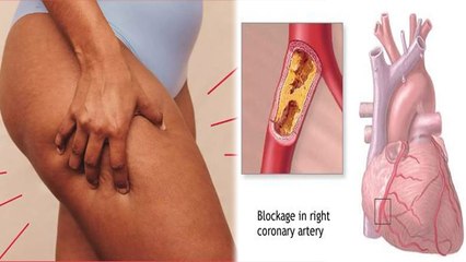 जांघ में सूजन के कारण, BP High से लेकर Heart Blockage का खतरा | Boldsky *Health