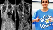 13 age की Girl की Spine की Bone हो गई थी टेढ़ी, Doctors ने लगा दी Rope । Boldsky *Health